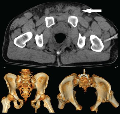 Ct Reconstruction Demonstrating Open Book Pelvic Fracture The White Download Scientific