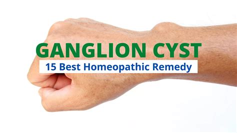 15 Best Homeopathic Remedy For Ganglion Cyst Treatment Dr Pranjali