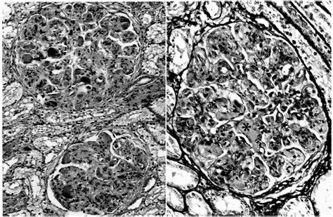 Two Glomeruli With Diffuse Endocapillary Cell Proliferation Lobular