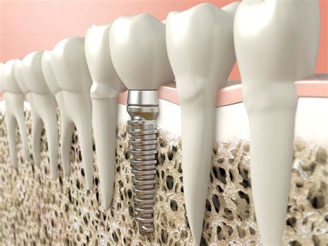 Solace Oral Surgery Dental Implants To Restore Your Smile