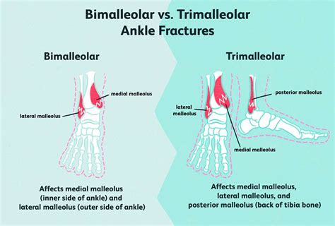 Bimalleolar And Trimalleolar Ankle Fractures Causes And Off