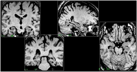 Parahippocampal Gyrus Mri