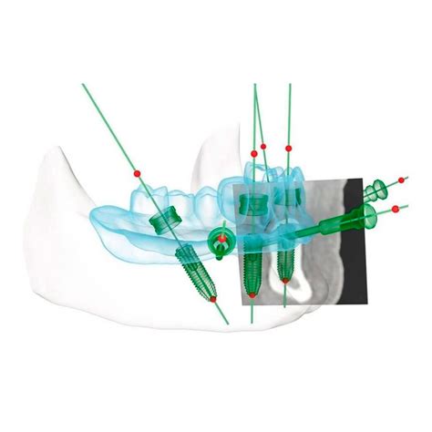 Cirugía guiada de implantes dentales Clínicas Hernadent