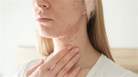 Cystic Acne Needs More Than Just Otc Treatments Heres What To Know