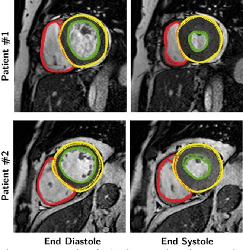 Figure 1 From Automated MRI Based Biventricular Segmentation Using 3D