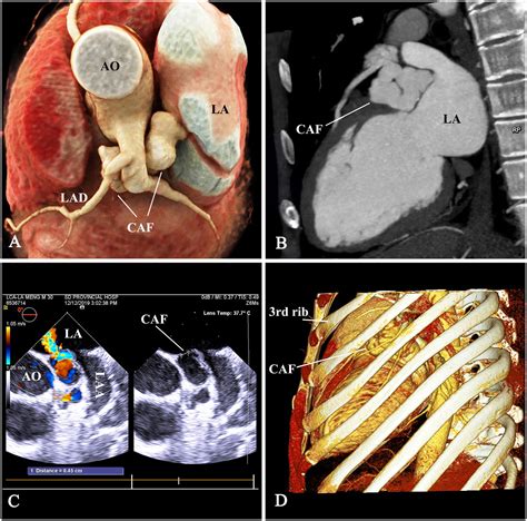 Frontiers Case Report Percoronary Device Closure Of Tortuous