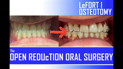 In The Or Underbite Fix Complete Jaw Surgery Lefort I Orthognathic Youtube