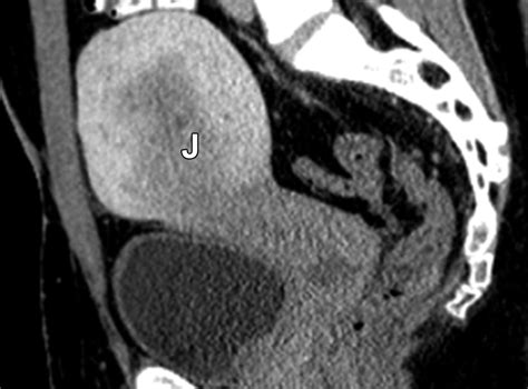 Normal Or Abnormal Demystifying Uterine And Cervical Contrast