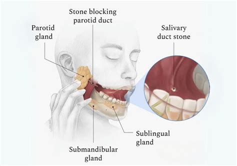 Salivary Gland Duct Stones Reconface India