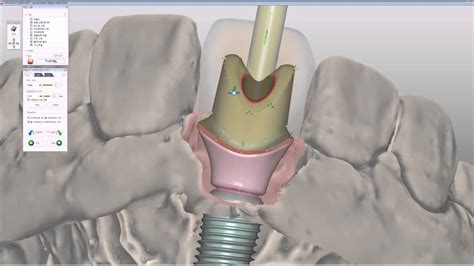 Customized Zirconia Abutment On Titanium Base Cad Design Youtube