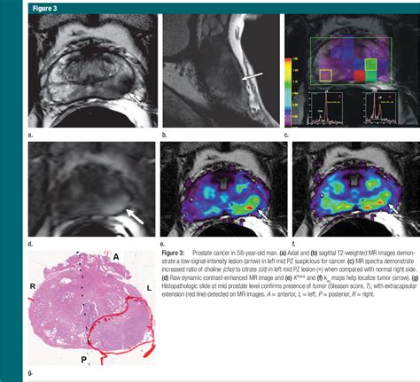 Figure 1 From Prostate Cancer Value Of Multiparametric Mr Imaging At 3