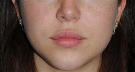 Can You Do Fat Transfer To Your Lips Lipstutorial Org