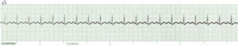 EKGs Flashcards Quizlet