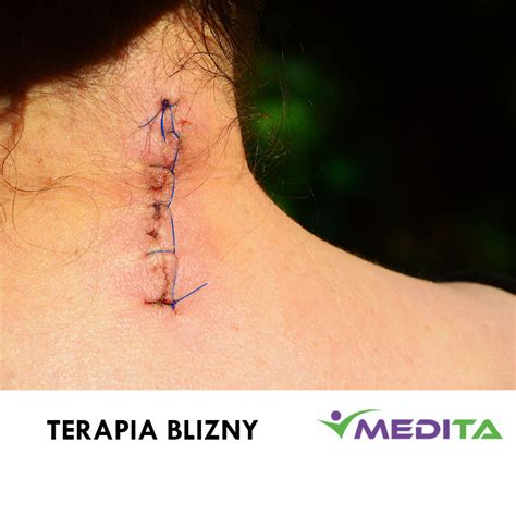 Terapia Blizny Medita