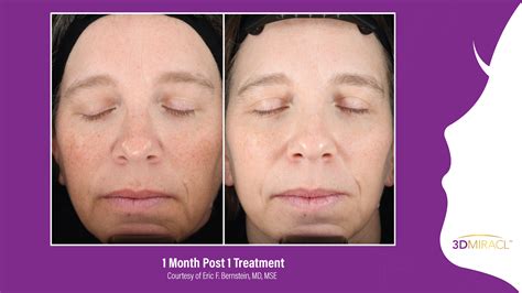 UltraClear Laser Boynton Beach Facial Rejuvenation In West Palm Beach FL