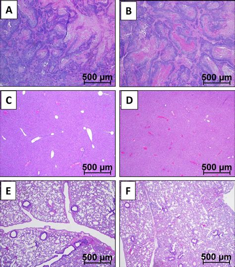 Histotripsy For The Treatment Of Cholangiocarcinoma In A Patient