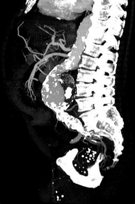 Aortic Stiffness And Disease Circulation