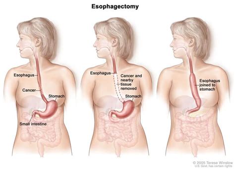 Esophageal Surgery