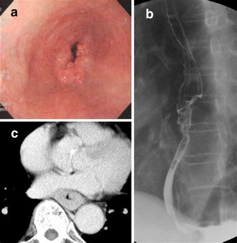 Upper Gastrointestinal Endoscopy And Upper Gastrointestinal Series