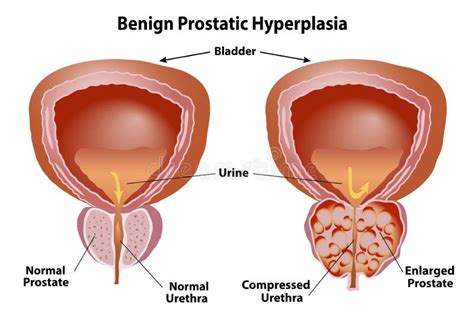 Prostata Vergrößert Mit Gutartiger Hyperplasie Vektor Abbildung