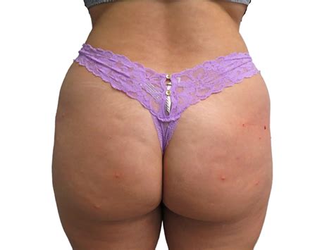 Sculptra Brazilian Butt Lift In Tampa For Hip Dips