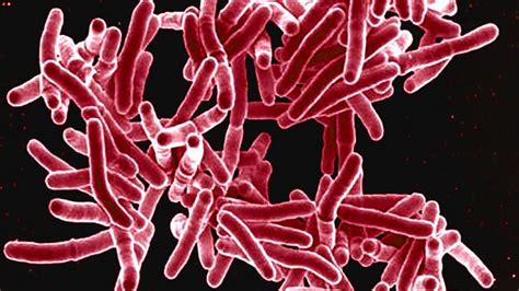 Glossary of Tuberculosis Terms | Tuberculosis (TB) | CDC