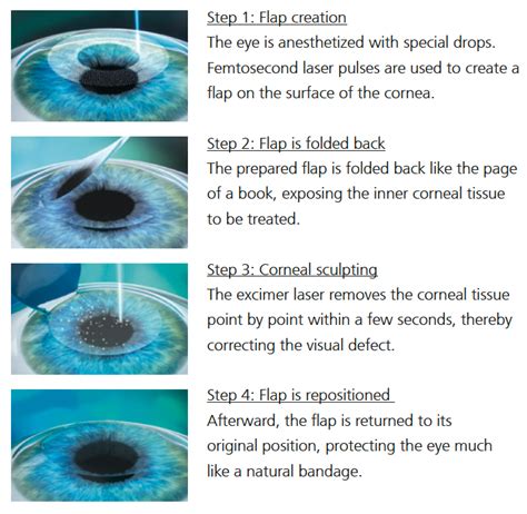 LASIK Vs SMILE Clearvision Eye Clinic LASIK Centre Singapore