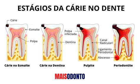 Dente Inchado O Que Fazer