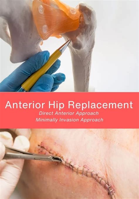 Anterior Hip Replacement Recovery Guide By Week