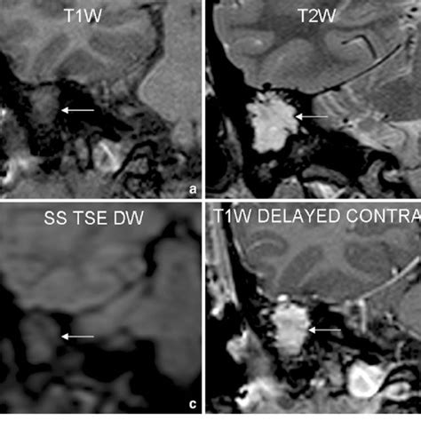 Case 2 30 Year Old Female Patient Was Operated For Right Sided