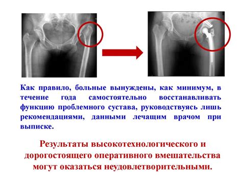Эндопротезирования тазобедренного сустава - презентация онлайн