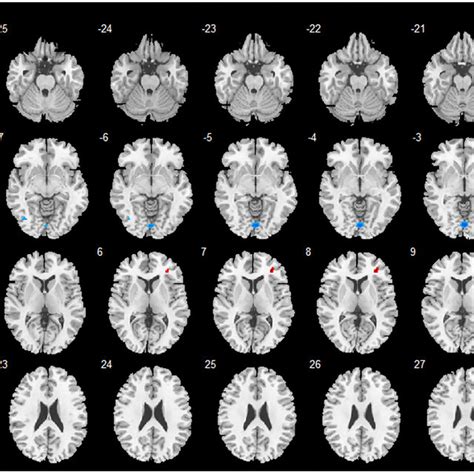 Brain Regions Identified By Whole Brain Vbm Analysis The Color Bar