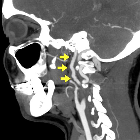 Fibromuscular Dysplasia Involving Internal Carotid Artery Image