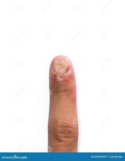 Fungal Nail Infection. Onychomycosis, Also Called Tinea Unguium Stock