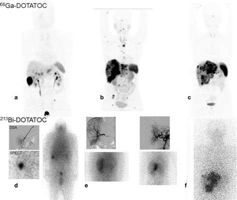 Bi Dotatoc Receptor Targeted Alpha Radionuclide Therapy Induces