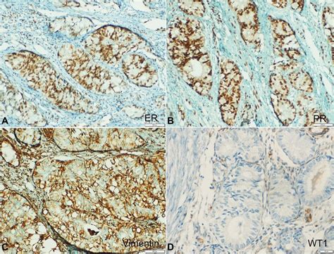 Photomicrograph Of The Tumor Showing IHC Profile A ER Immunostain