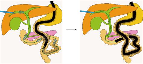 Figure 2 From Innovations And Techniques For Balloon Enteroscope Assisted Endoscopic Retrograde