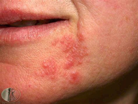 Perioral Dermatitis Forehead