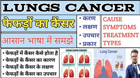 Lungs Cancer फेफड़ों का कैंसर Lungs Cancer In Hindi Lungs Cancer Pathology Lungs Cancer