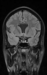 Septo Optic Dysplasia Image Radiopaedia Org