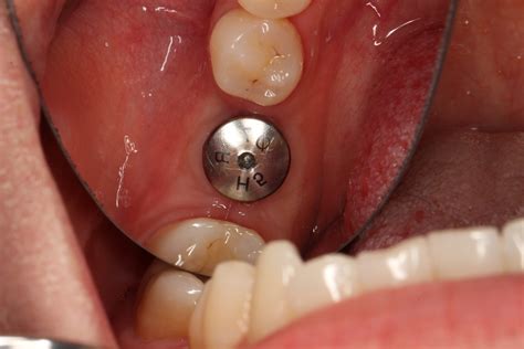 Types Of Provisional Crowns At Shaybsingletono Blog