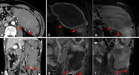 CT and MRI of the abdomen. a Contrast-enhanced CT revealed a large ...