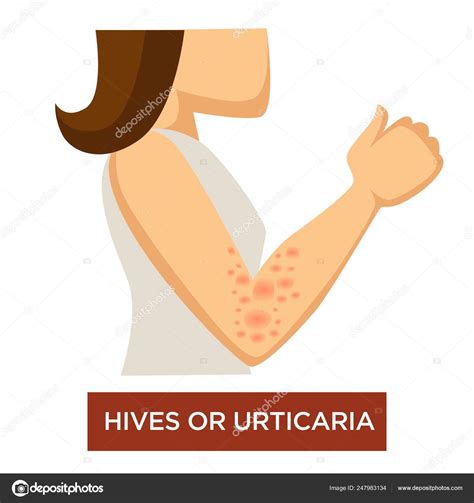 Enfermedad Inmune Urticaria Urticaria Carácter Femenino Aislado Mano Con Piel Vector Gráfico