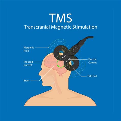 Transcranial Magnetic Stimulation Tms Therapy Near Chicago