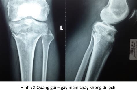 Tìm hiểu những hình ảnh xương mâm chày đặc biệt và độc đáo