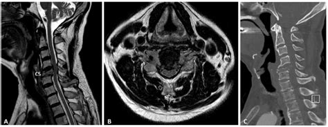 Preoperative Cervical MRI Sagittal A Axial B And CT Sagittal C