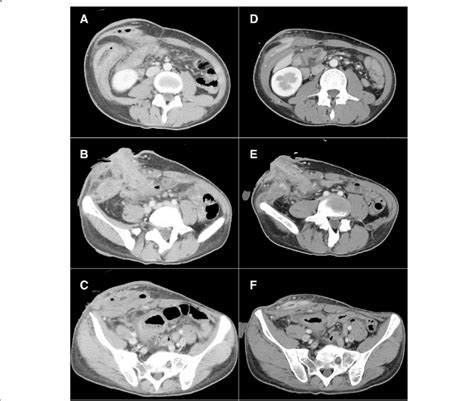 Representative Abdominal Contrast Enhanced Ct Scans A C Images Download Scientific Diagram