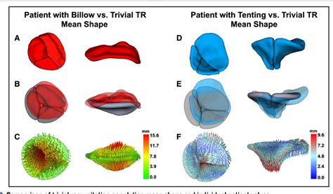 Modeling Of The Tricuspid Valve And Right Ventricle In Hypoplastic Left