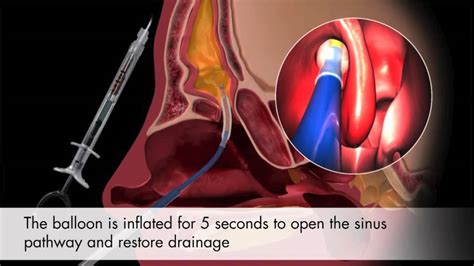 Balloon Sinuplasty Animation Patient Testimonials Houston Sinus