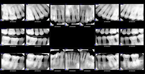 Full Mouth Series Template